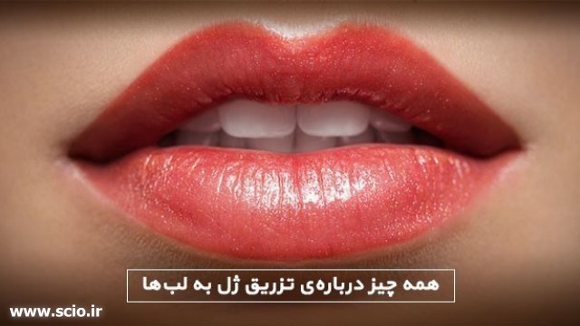 تزریق ژل به لب